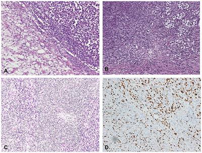 Case Report: The Complete Remission of a Mixed Germ Cell Tumor With Somatic Type Malignancy of Sarcoma Type With a GCT-Oriented Therapy: Clinical Findings and Genomic Profiling